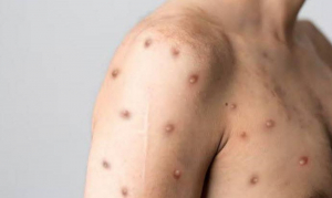 Viruela del mono ahora se llamar&aacute; &lsquo;mpox&rsquo; tras m&aacute;s de 81 mil casos en el mundo