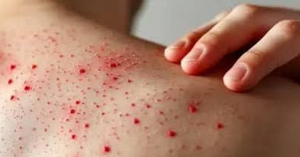 Brote de sarampi&oacute;n suma m&aacute;s de 7 mil casos en M&eacute;xico