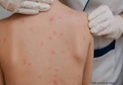 Cierran primaria por brote de varicela