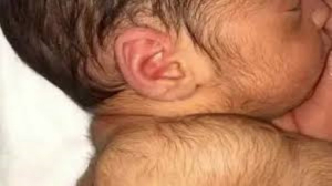 Medicamento contra la calvicie provoca beb&eacute;s con &laquo;s&iacute;ndrome del hombre lobo&raquo;