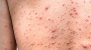 M&eacute;xico llega a 386 casos de viruela del mono; contagios se registran en 24 estados