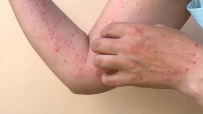 Sube a 16 casos de viruela s&iacute;mica