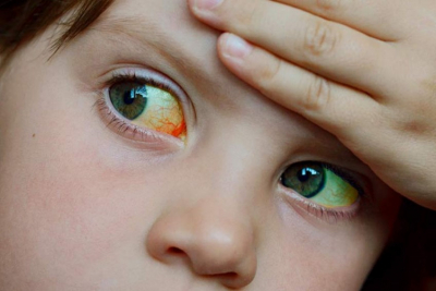 Reportan 5 casos probables de hepatitis aguda grave en menores de 5 años