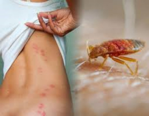 Estos son los peligros de las picaduras de chinche