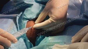 Sector salud har&aacute; campa&ntilde;a de vasectom&iacute;a sin bistur&iacute;