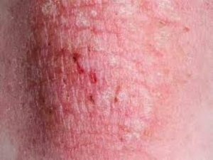 Alertan por nueva enfermedad de transmisi&oacute;n sexual altamente contagiosa