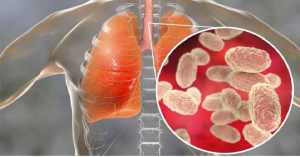 Emiten alerta Epidemiol&oacute;gica por tosferina en Tamaulipas