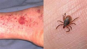 Confirman un caso de Rickettsia por picadura de Garrapata en Nuevo Laredo