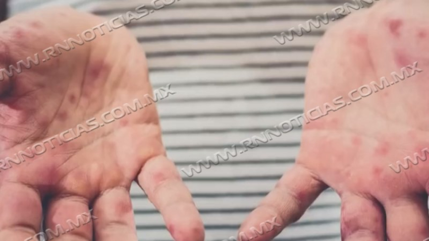 Se confirman los primeros casos de Coxsackie en Nuevo Laredo: alerta sanitaria en Tamaulipas