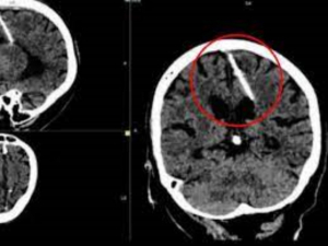 Abuelita se entera que tuvo una aguja en el cerebro por 80 a&ntilde;os