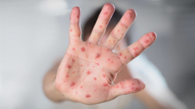 VIDEO Contin&uacute;a alerta epidemiol&oacute;gica en Nuevo Laredo por casos de Sarampi&oacute;n