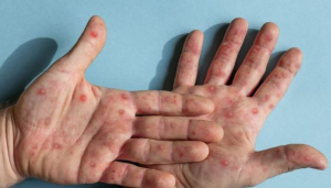 Confirman 4 muertes por viruela del mono y m&aacute;s de 3 mil contagios en M&eacute;xico
