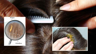 Alerta SSA por plaga de piojos