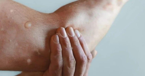 Muere paciente de 24 años diagnosticado con viruela símica en Cancún