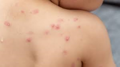 Levantan muro sanitario contra viruela s&iacute;mica