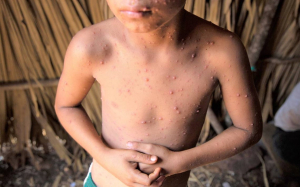 35 niños contagiados de varicela en primaria de Madero