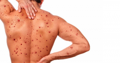 Descarta SST viruela símica en Tamaulipas