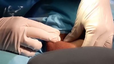 VIDEOR Sector salud har&aacute; campa&ntilde;a de vasectom&iacute;a sin bistur&iacute;