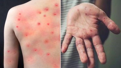 Detectan caso sospechoso de viruela del mono: es un niño reynosense