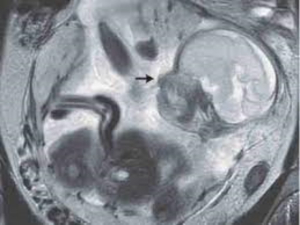 Mujer con calambres estomacales descubre que un beb&eacute; se desarrollaba en su intestino