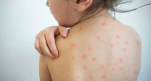 Salud emite alerta por casos importados de sarampi&oacute;n en M&eacute;xico