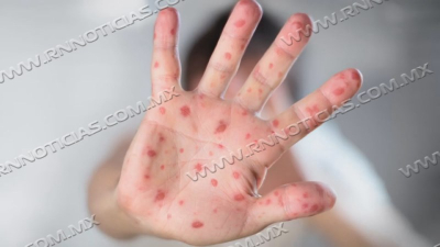 Nuevo Laredo en alerta epidemiológica por casos de sarampión en Estados Unidos