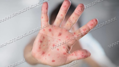 Nuevo Laredo en alerta epidemiol&oacute;gica por casos de sarampi&oacute;n en Estados Unidos