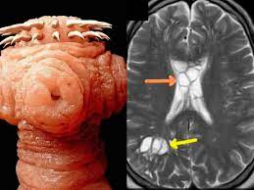 Hombre descubre que sus migrañas eran ocasionadas por un gusano en su cerebro