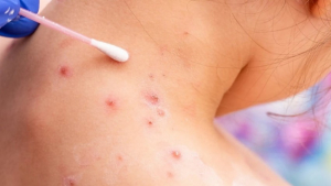 Alerta OMS ante aumento de casos de viruela del mono