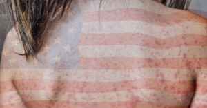 Estados Unidos emite alerta sanitaria por el contagio de sarampión, ¿esto afectará a México?