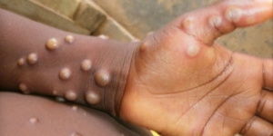 EU monitorea a 200 personas por exposición a viruela de mono