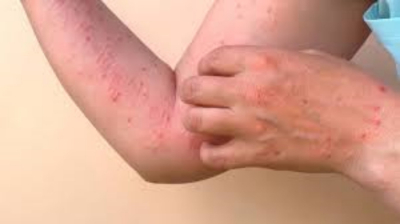 Hay 31 casos confirmados de Viruela de Mono en Tamaulipas